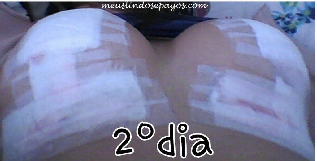 Meus, Lindos e Pagos! » Arquivos » Silicone nos seios 300 ml ISD