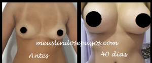 antes e depois seios