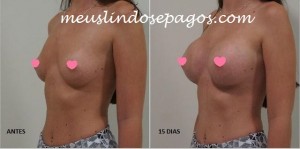 antes e 15 dias
