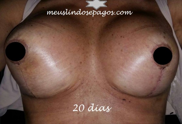 20dias