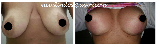 antes e depois