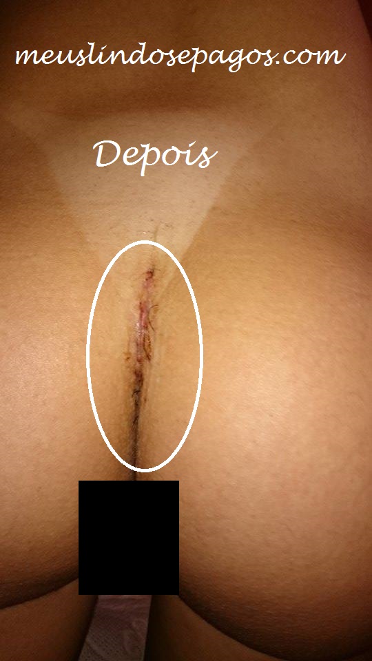 depois4