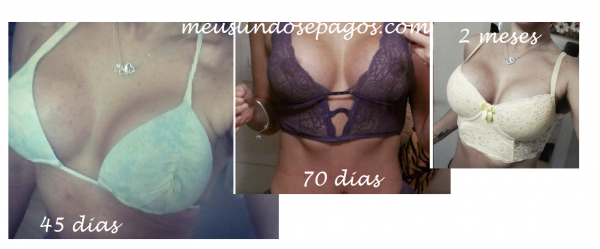 Mastopexia