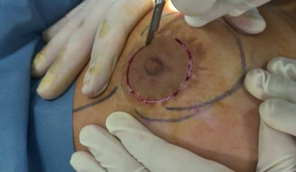 periareolar1