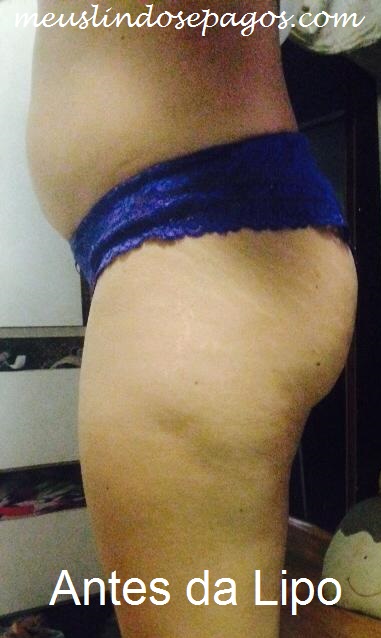 antes da lipo2