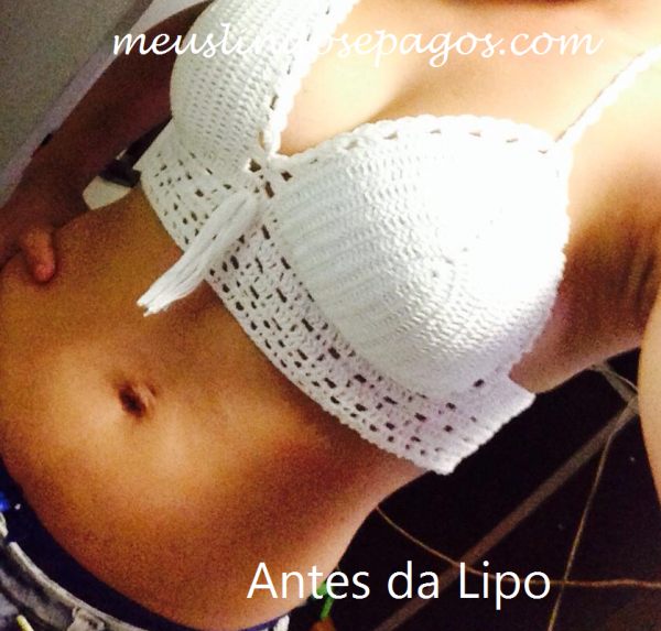 antes da lipo3