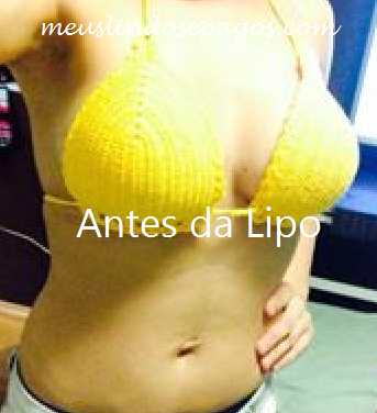 antes da lipo4