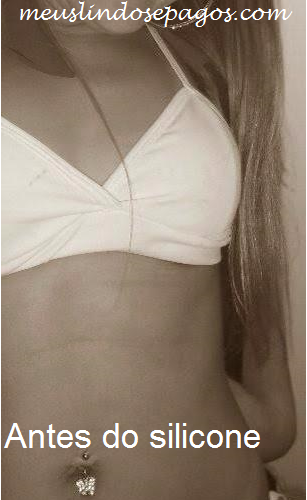 antes do silicone
