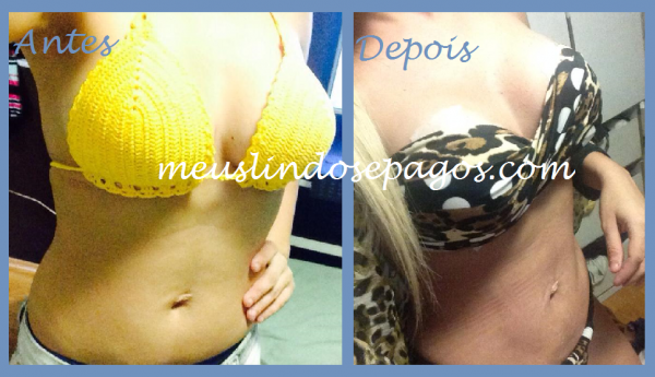 mont-antes e depois da lipo2