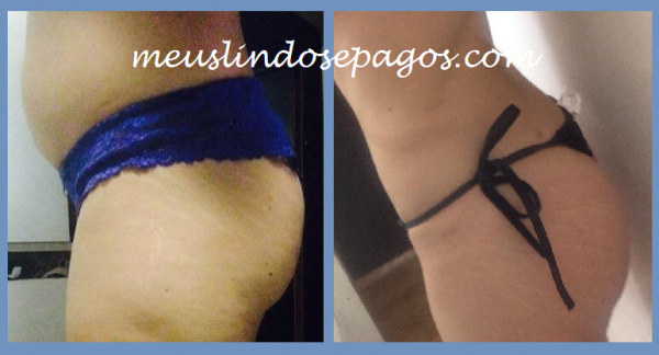 mont-antes e depois da lipo3