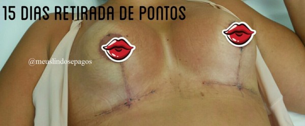 15dias retirada pontos