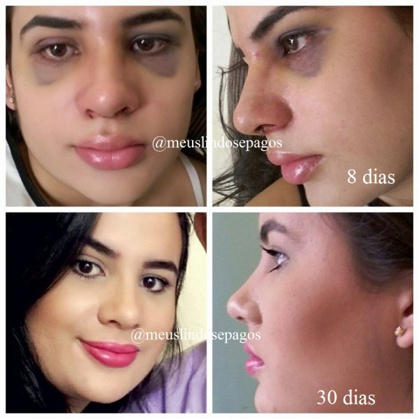 dia retirada tala 8 dias e 30 dias-1