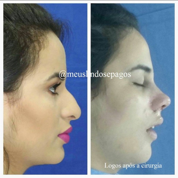 logo depois da ciru antes da tala-1