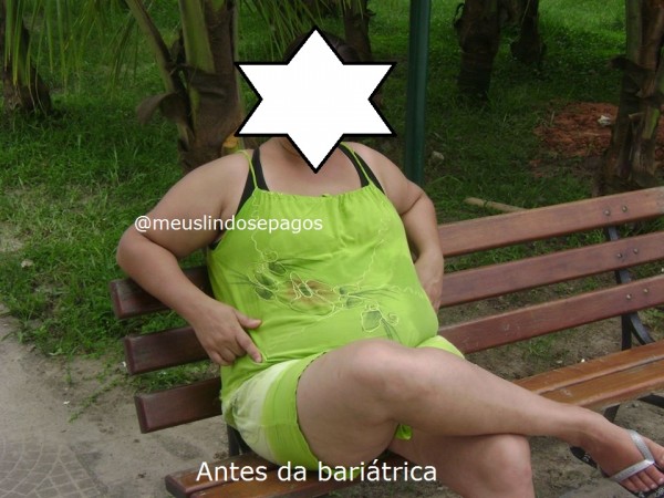 antes da bariatrica
