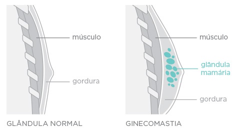 ginecomastia-PAINT