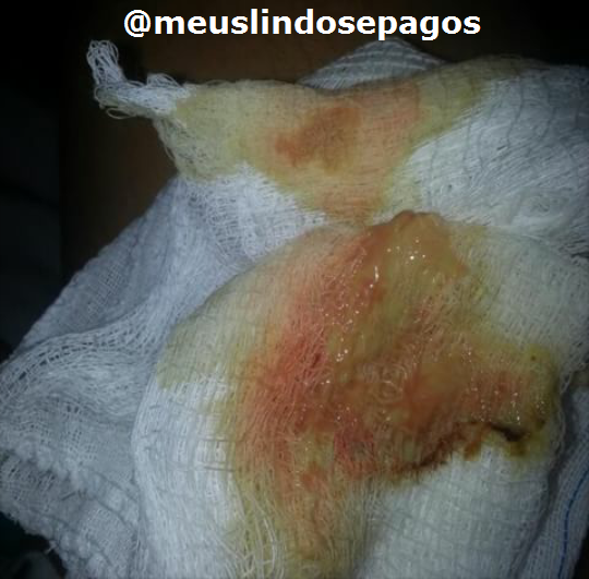 secreções que saiam1