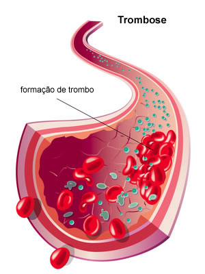 trombose-doenca