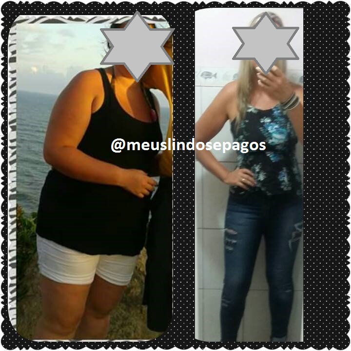 Meus, Lindos e Pagos! » Arquivos » Abdominoplastia com lipoaspiração