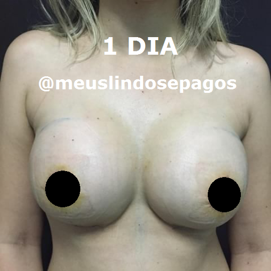 1DIA