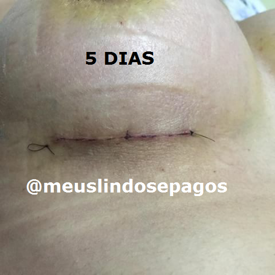 5DIAS CICATRIZ