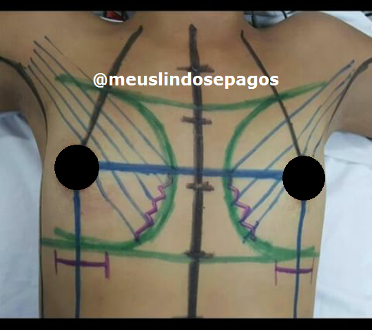 antes1